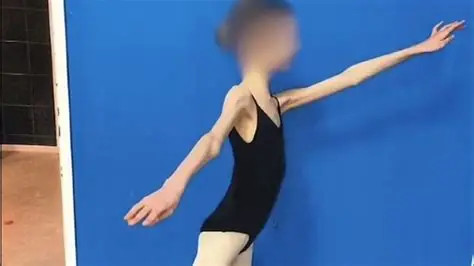 Devojčicu doveli u bolnicu, imala je samo 28 KG I RUČICE TANKE KAO GRISINE: Kad su lekari shvatili koliko ima godina, samo su se UHVATILI ZA GLAVU Devojčicu doveli u bolnicu, imala je samo 28 KG I RUČICE TANKE KAO GRISINE: Kad su lekari shvatili koliko ima godina, samo su se UHVATILI ZA GLAVU - featured image