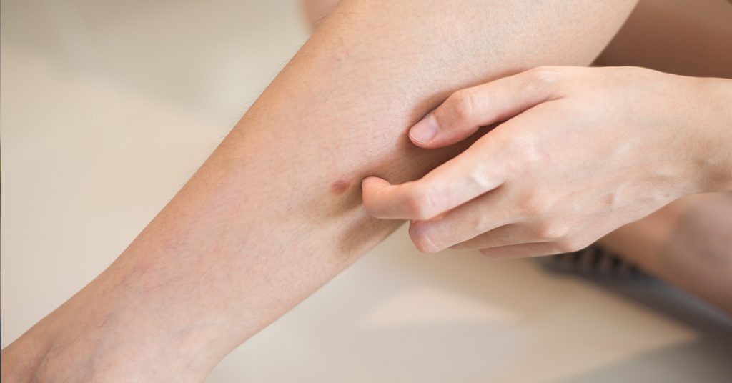 „Šta uzrokuje svrab na različitim dijelovima tijela: kada je bezopasan, a kada potražiti savjet ljekara“ - featured image